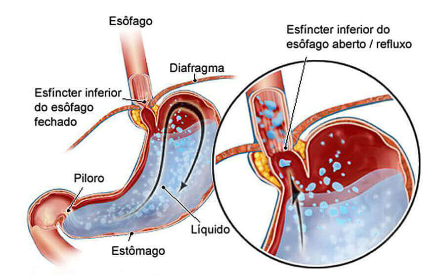 DRGE (1)