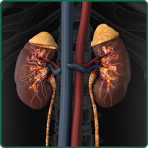 Chronic Kidney Disease and Kidney Failure: Treatment and Prevention Options