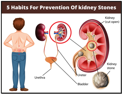 How Long is the Typical Recovery Period After Undergoing Treatment for Urinary Stones?