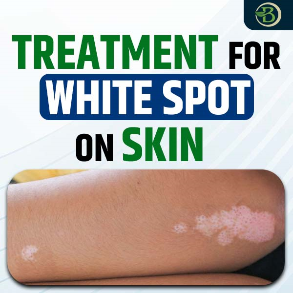 Vitiligo Treatment Naturally: Effective Remedies for Skin Pigmentation