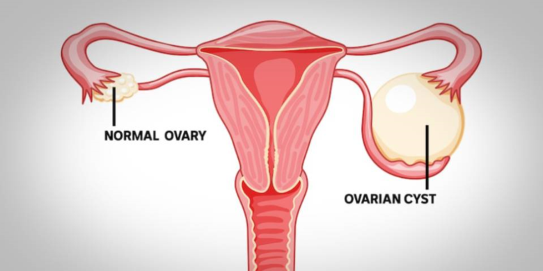 Ovarian Cyst: Causes, Symptoms, Diagnosis And Treatment