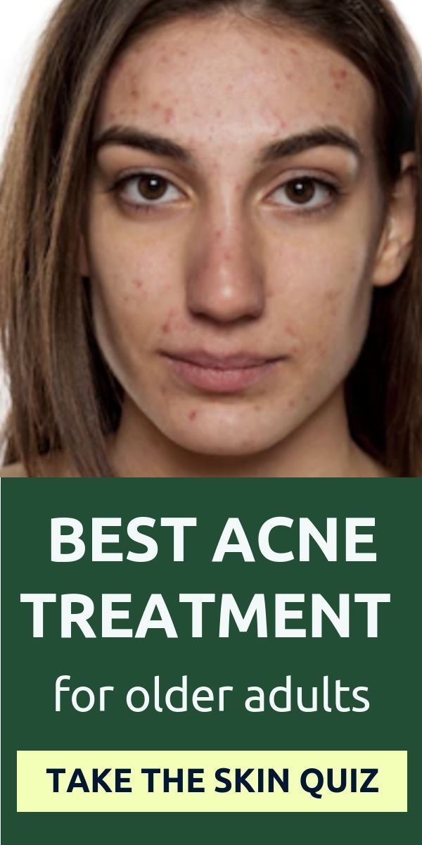 Professional Guide to Treating Severe Acne Safely