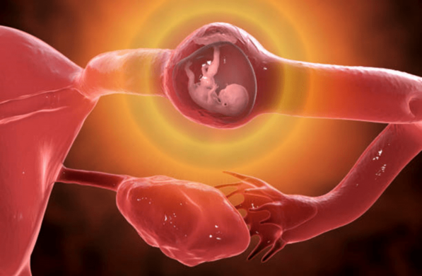 Ectopic Pregnancy After Tubal Ligation: What You Need to Know