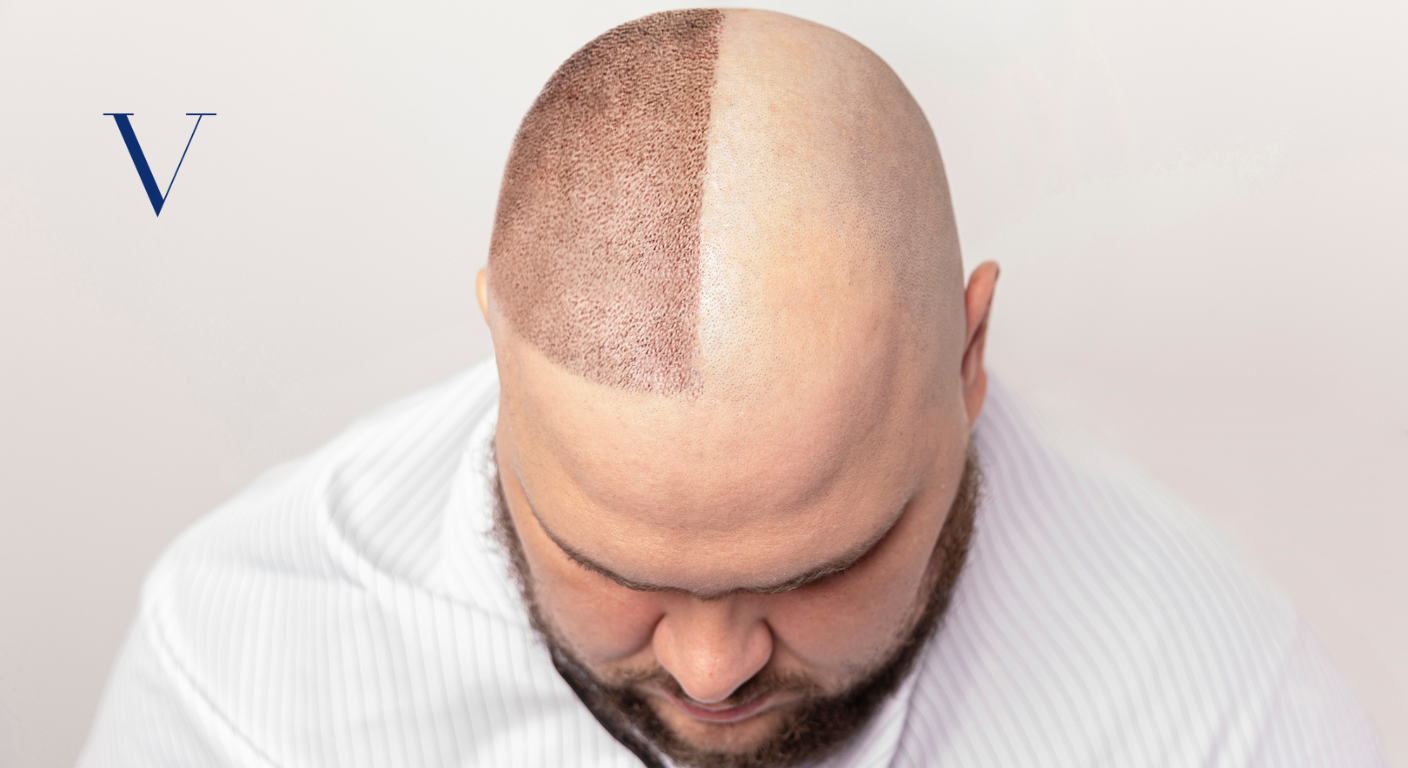 FUT Hair Transplant for Norwood for Baldness