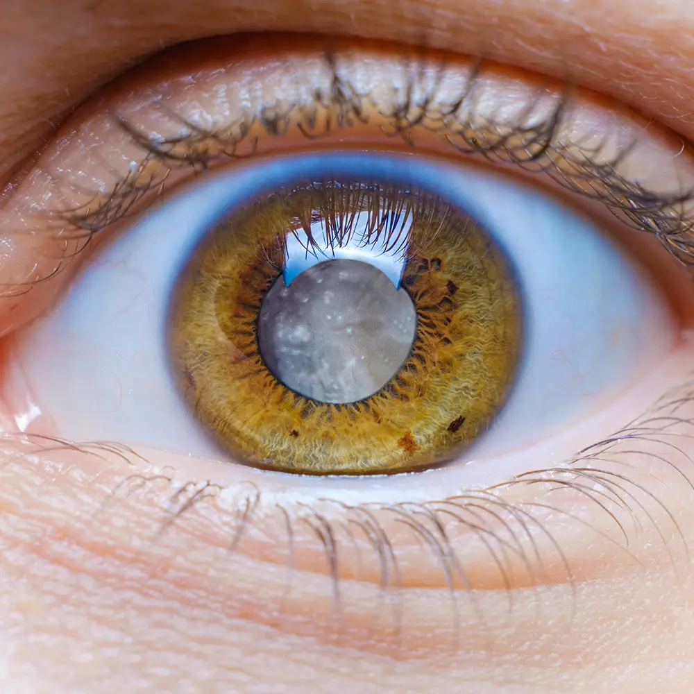 Why You Shouldn’t Delay Retina Treatment