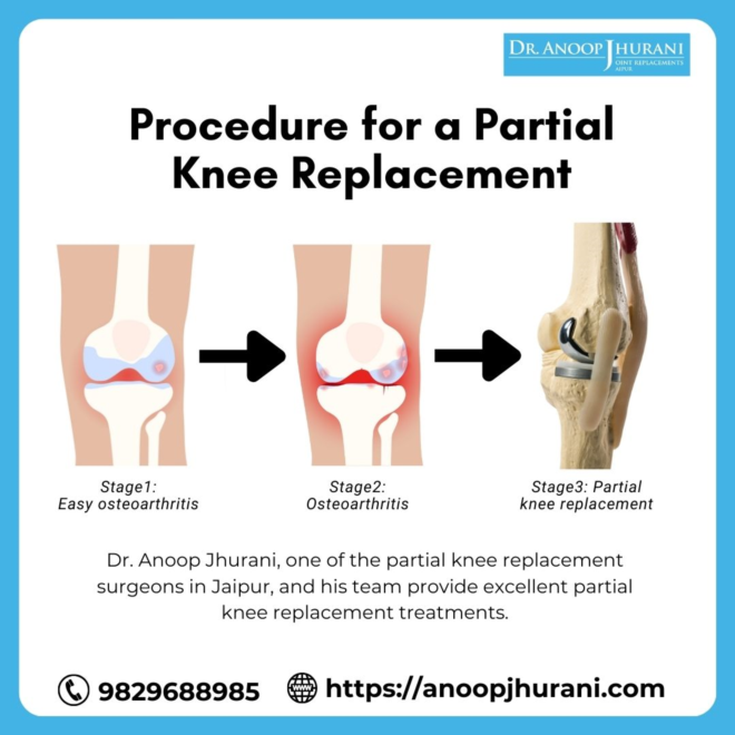  The Procedure for a Partial Knee Replacement