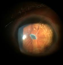 Eye Treatment Tourism in Indore, India: World-Class Eye Care
