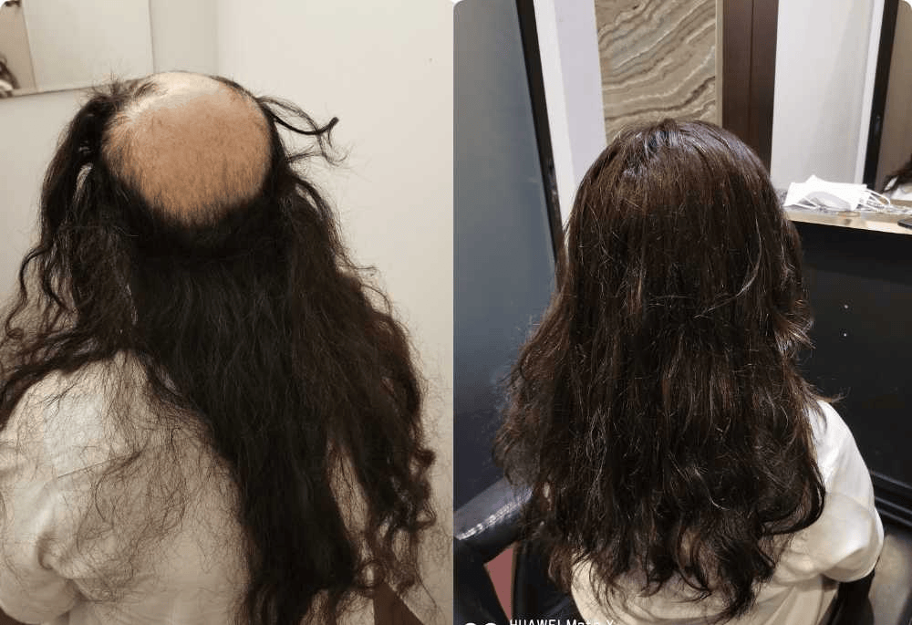 Hair Replacement SG