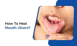 Glycerine Mouth Ulcers: A Natural Remedy That Heals Faster