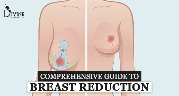 Breast Reduction Surgery Guide