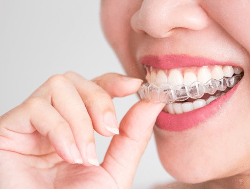 Invisalign in London, Ontario – Straighten Your Smile