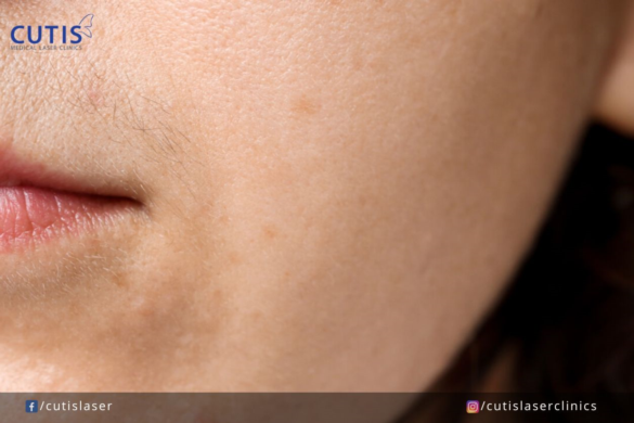 Peach Fuzz: How Can You Get Rid of It