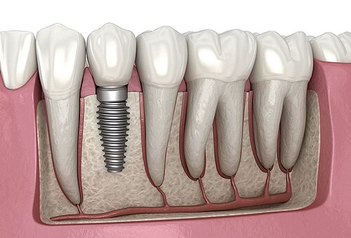 Why Your Next Vacation to Renew Your Smile