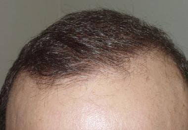 Hair Transplant in Dubai