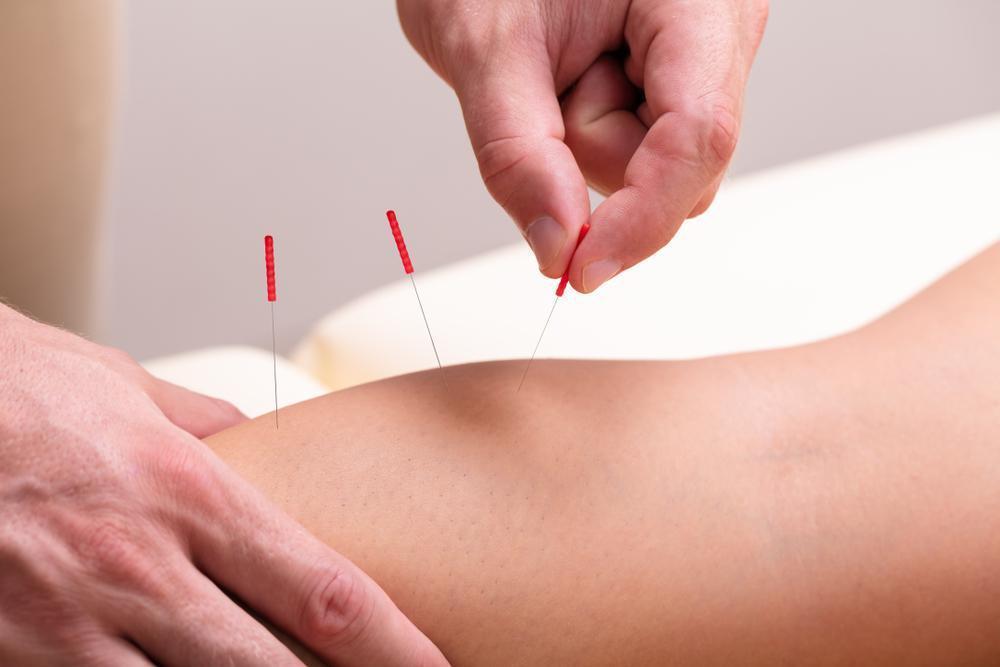 Dry Needling Therapy