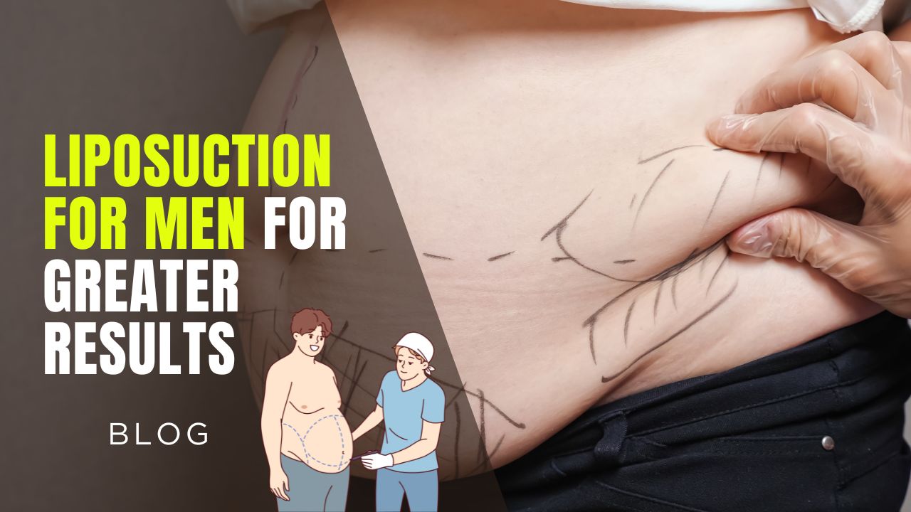 Consider liposuction for men for greater results