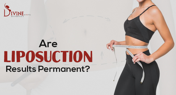Is Liposuction A Permanent Solution?