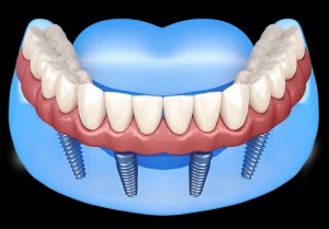 Full Mouth Dental Implants Albany