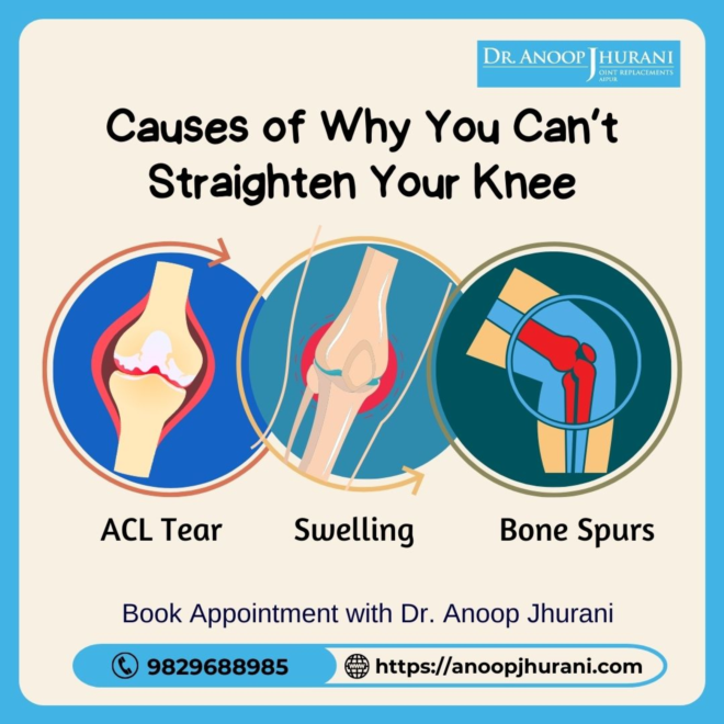 Causes of Why You Can’t Straighten Your Knee