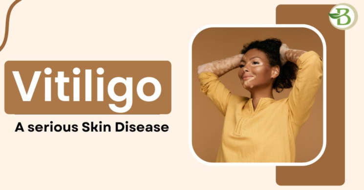 What exactly is Vitiligo Disease, and how can it be Treated? Vitiligo Disease Treatment