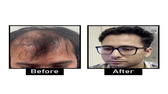 Hair loss treatments in Delhi