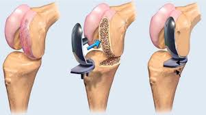 Live Pain-Free with Expert Total Knee Replacement