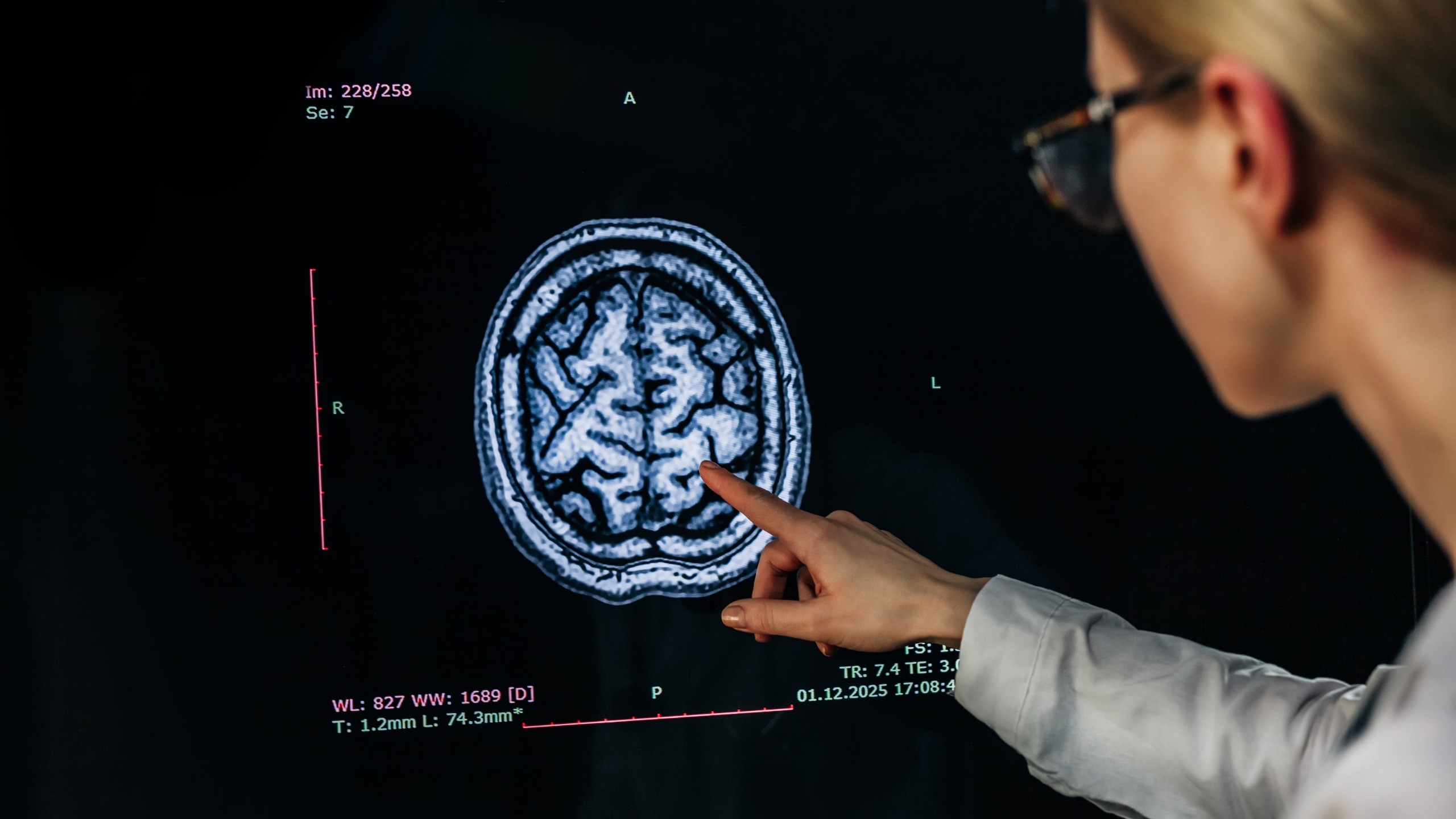 Lower Blood Pressure Targets Linked to Slower Brain Damage, Study Finds