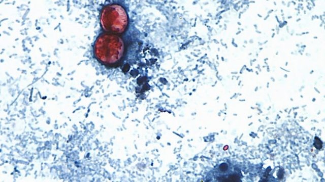Iowa Linked to Expanding Cyclosporiasis Outbreak as U.S. Cases Top 22,000