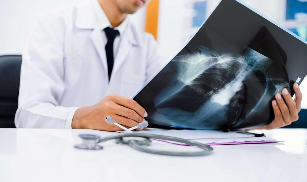 Dépistage cancer du poumon : la résistance s'organise