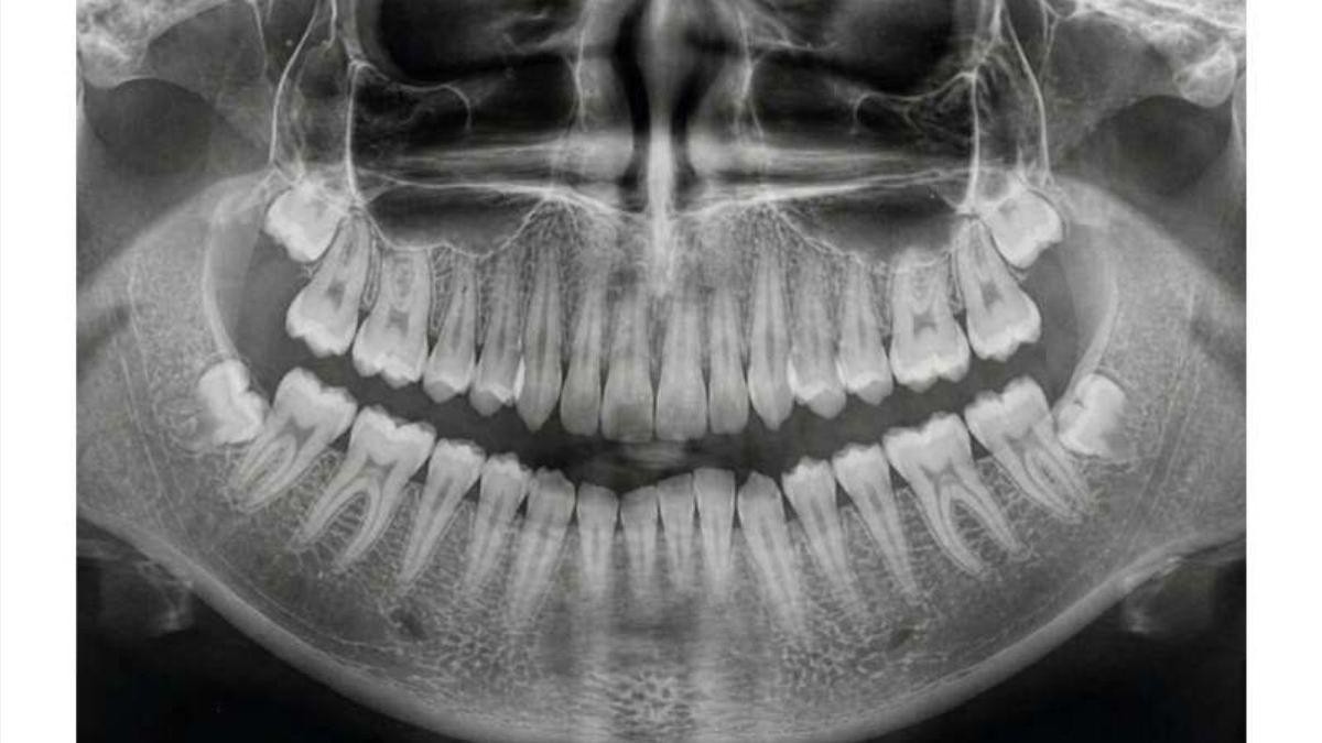 El 'nanohueso' que regenera huesos sin injertos dolorosos