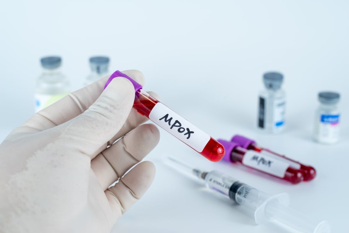 Virus mpox : deux virologues arrêtés avec 113 fioles aux USA